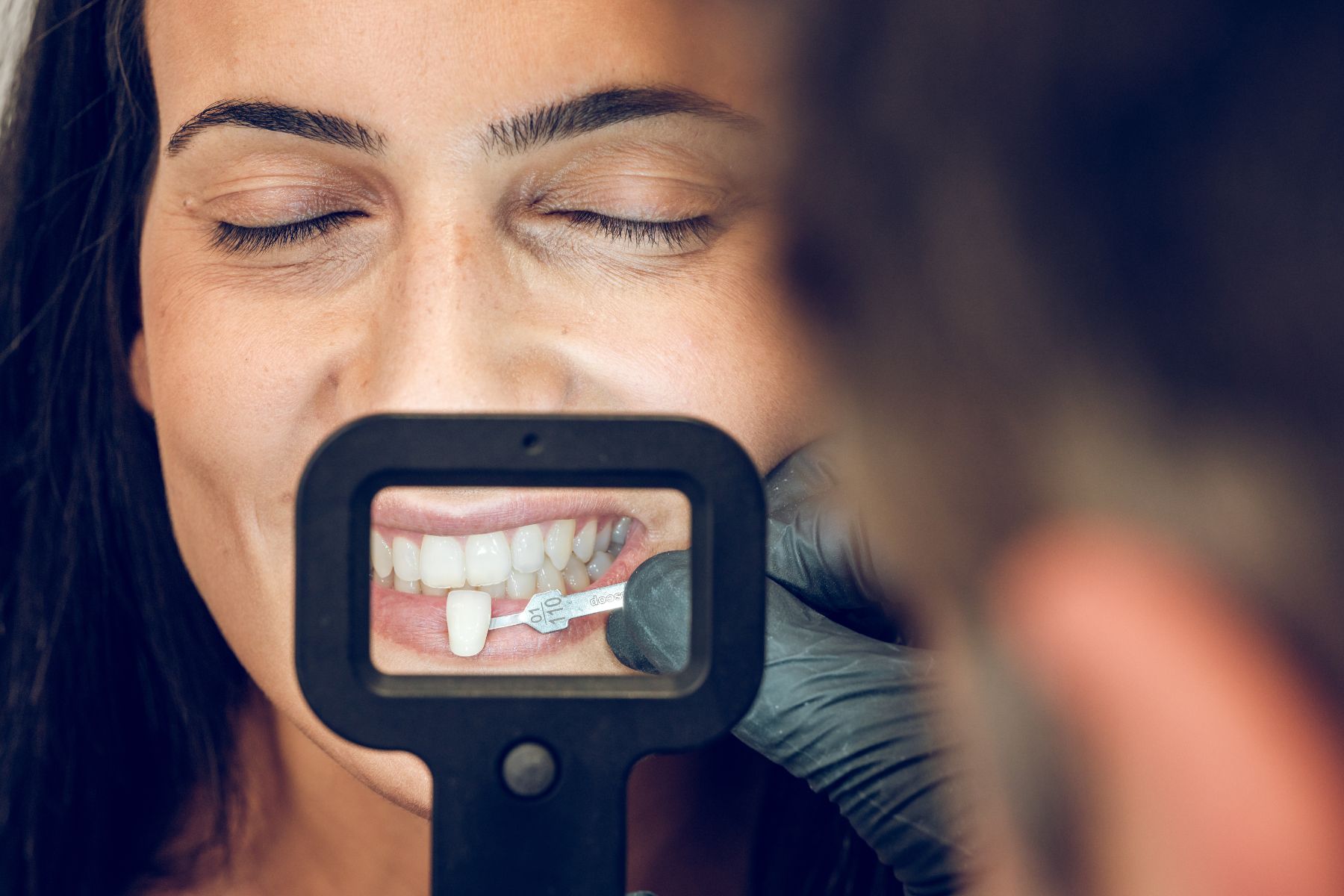 Porcelain veneers applied to upper teeth for aesthetic smile enhancement at Smile Center Turkey