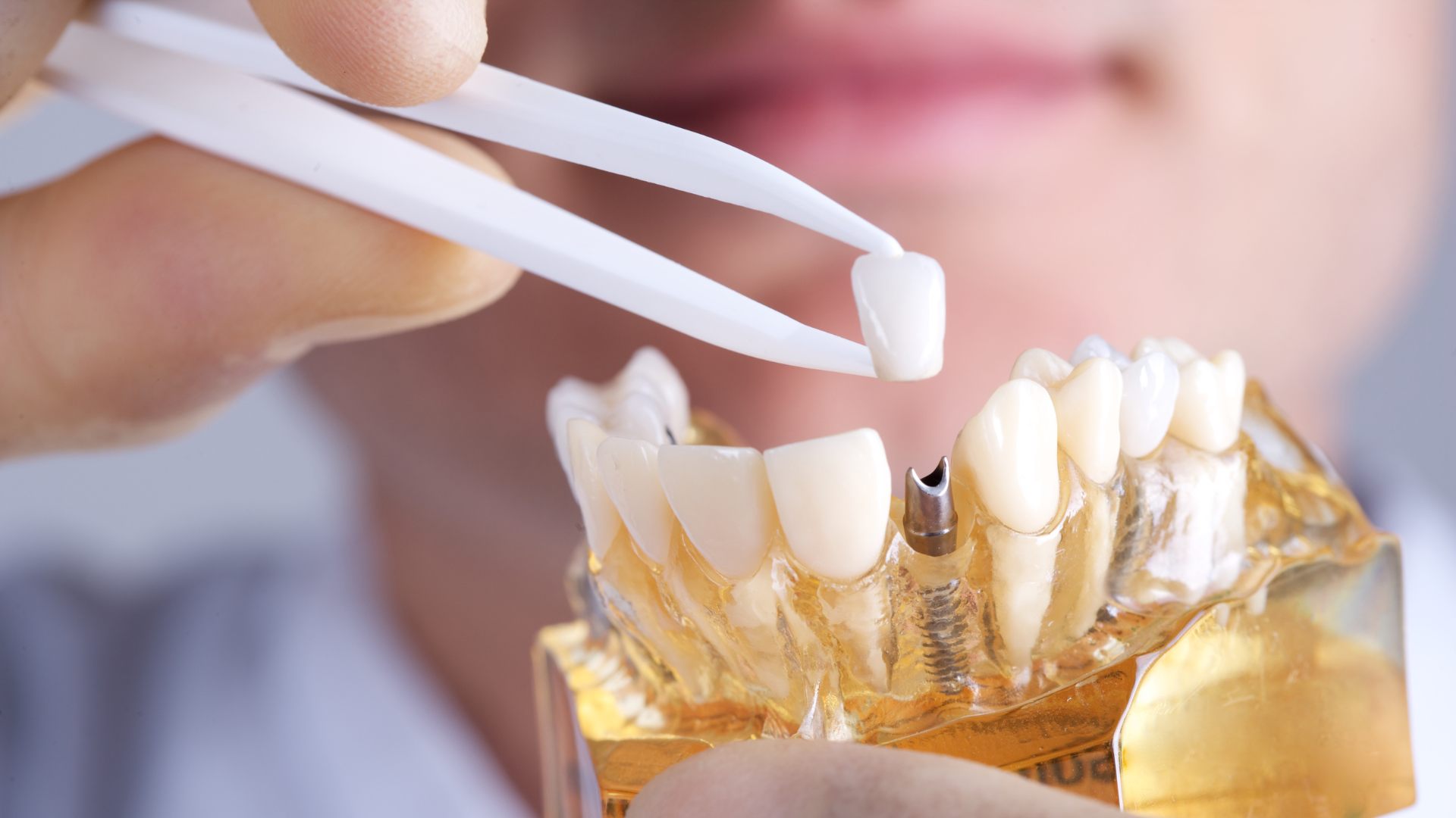 Close-up of a zygomatic dental implant procedure showing placement of a dental crown in Turkey