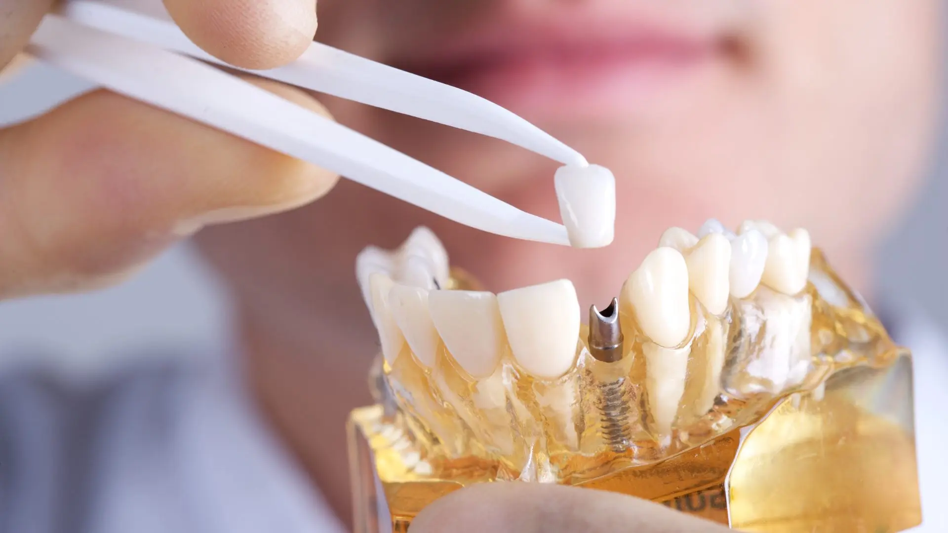 Close-up of a zygomatic dental implant procedure showing placement of a dental crown in Turkey