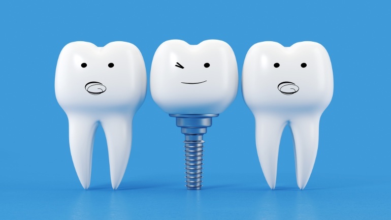 The Guide To Dental Implant Treatment In The UK