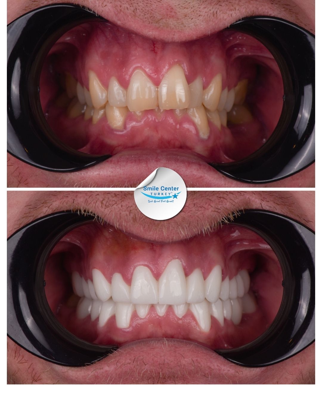 Brett – Smile Center Turkey®