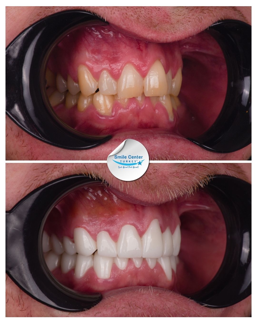 Brett – Smile Center Turkey®