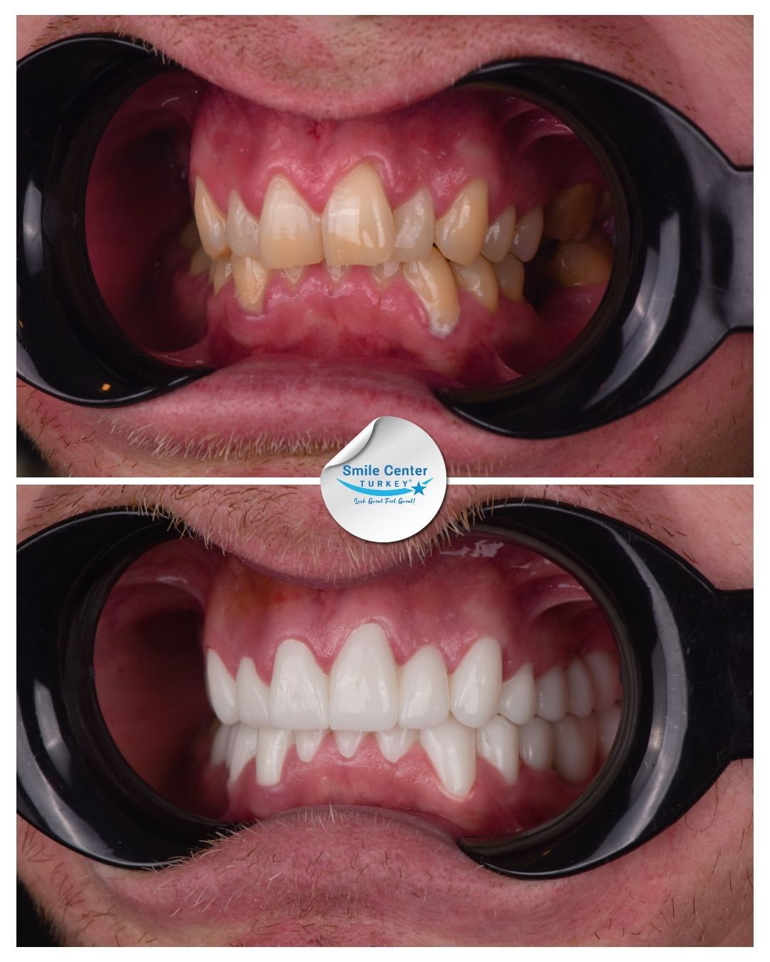 Brett – Smile Center Turkey®