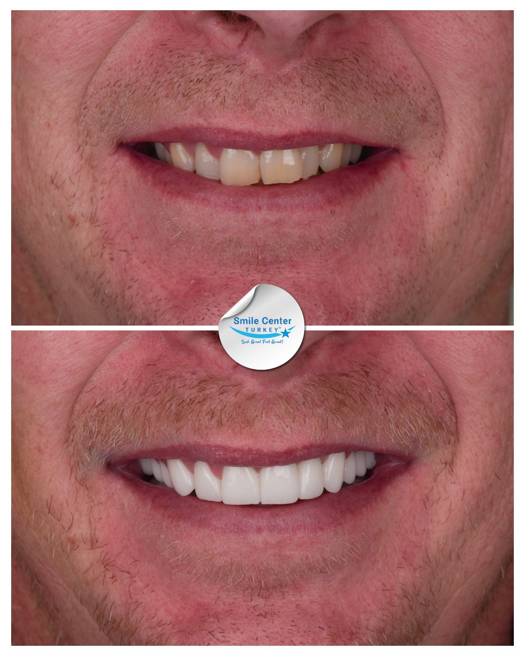 Brett – Smile Center Turkey®