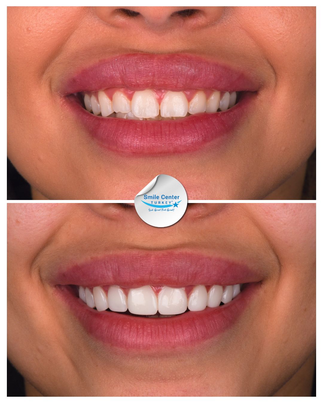 Brooklyn – Smile Center Turkey®