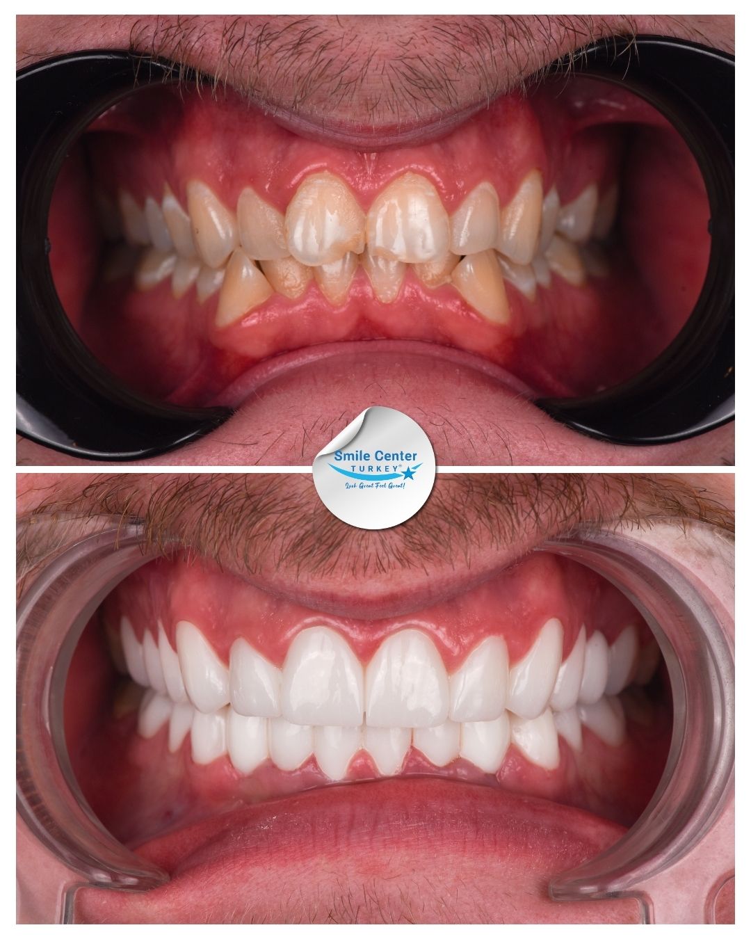 Before and after front view of a male patient's teeth with moustache showing misaligned, yellow teeth before treatment and straight white teeth after dental restoration at Smile Center Turkey.