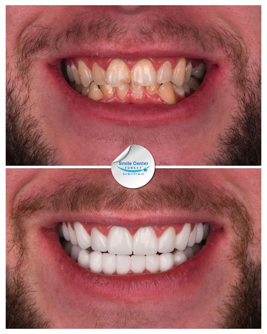 Before and after front view of a male patient's teeth with moustache showing severely decayed and misaligned teeth before treatment and straight white teeth after dental restoration at Smile Center Turkey.