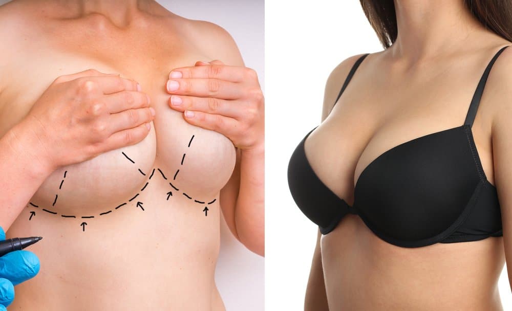 Breast-Lift-vs-Breast-Augmentation-1