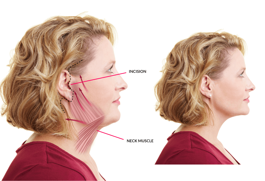 Necklift