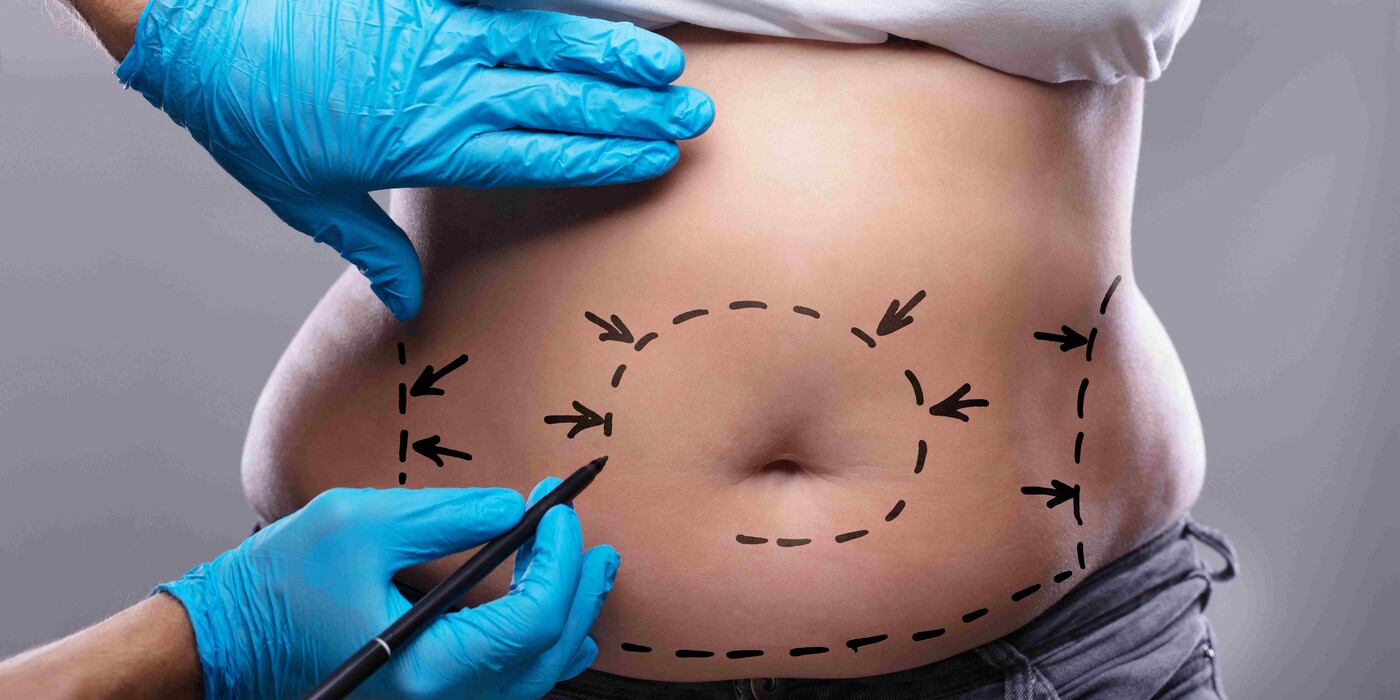 blog_Tummy Tuck Procedure_1500x750 (2)