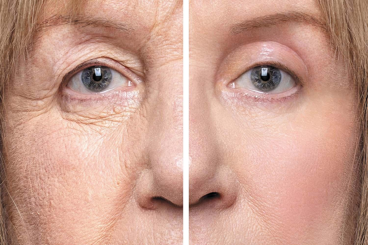 p3-blepharoplasty-hl0125-gi2169977799