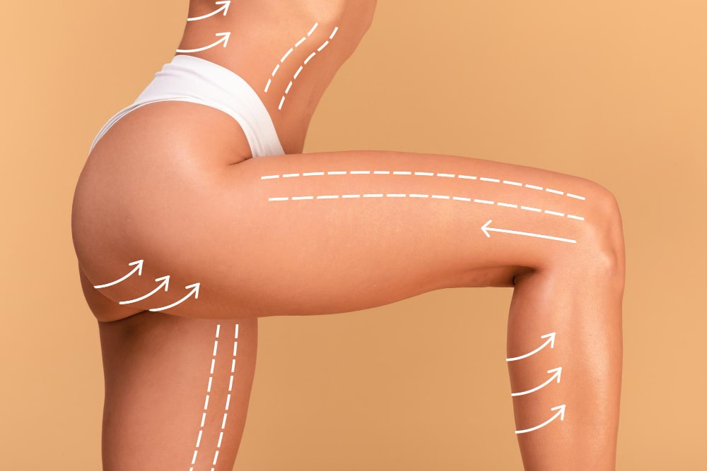 woman_with_thigh_lift_in_turkey_sculpted_thighs_20240229141817