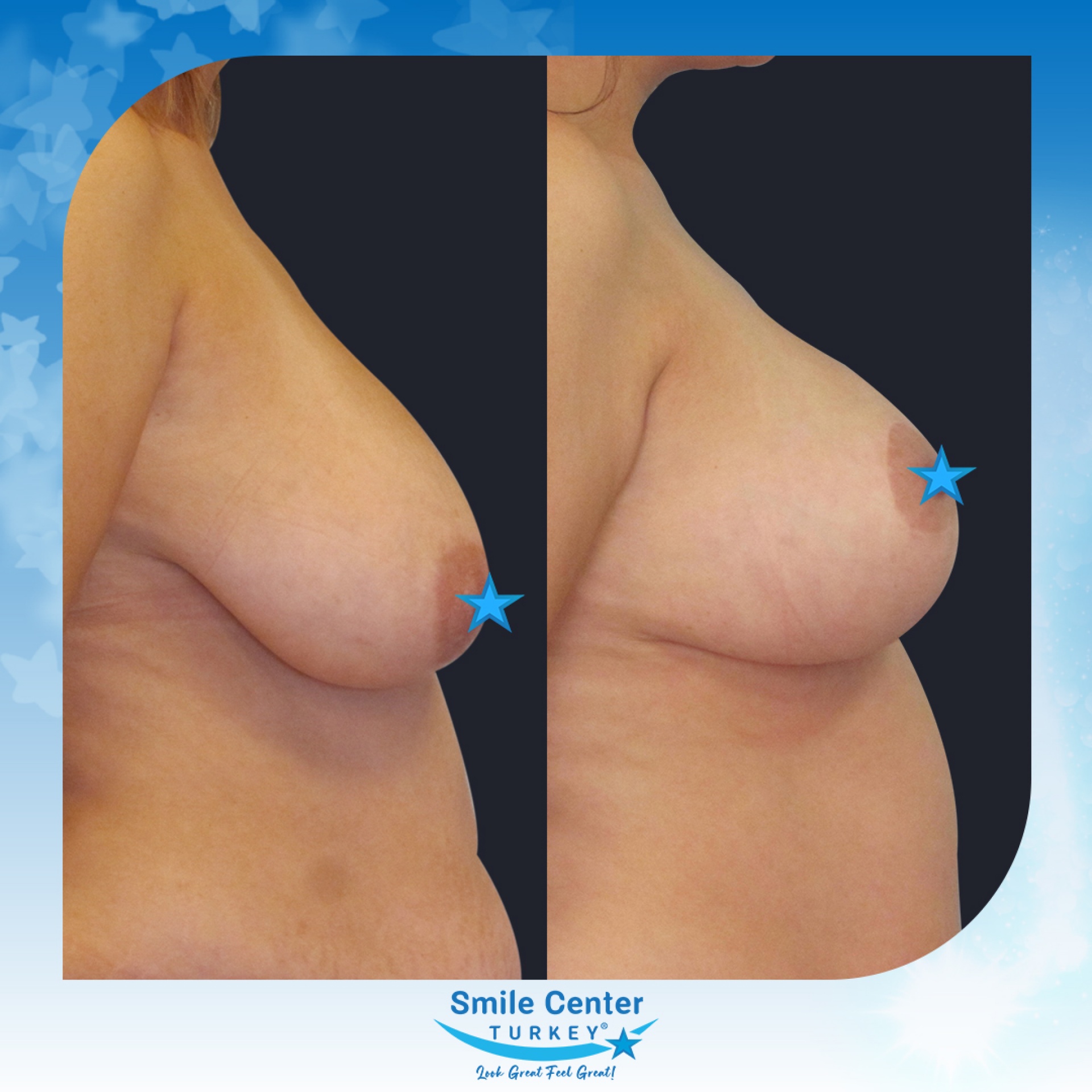 Before and after cosmetic surgery at Smile Center Turkey