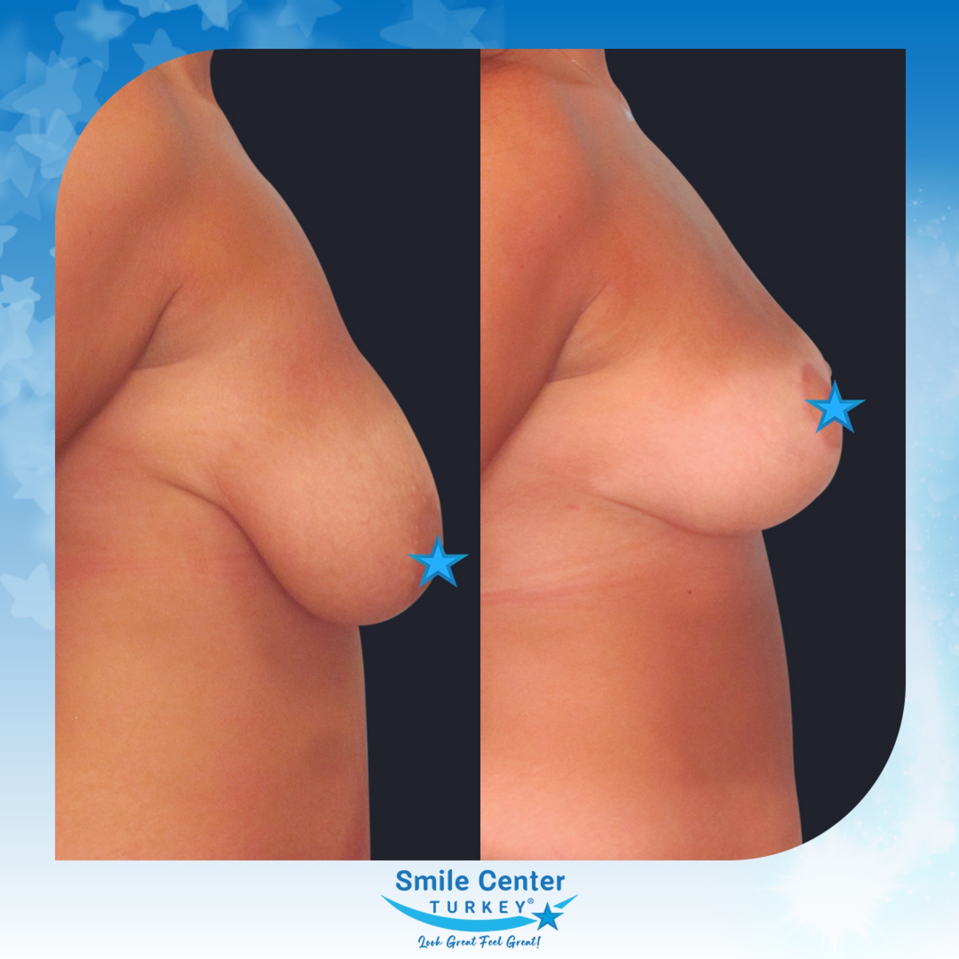 Before and after cosmetic surgery at Smile Center Turkey