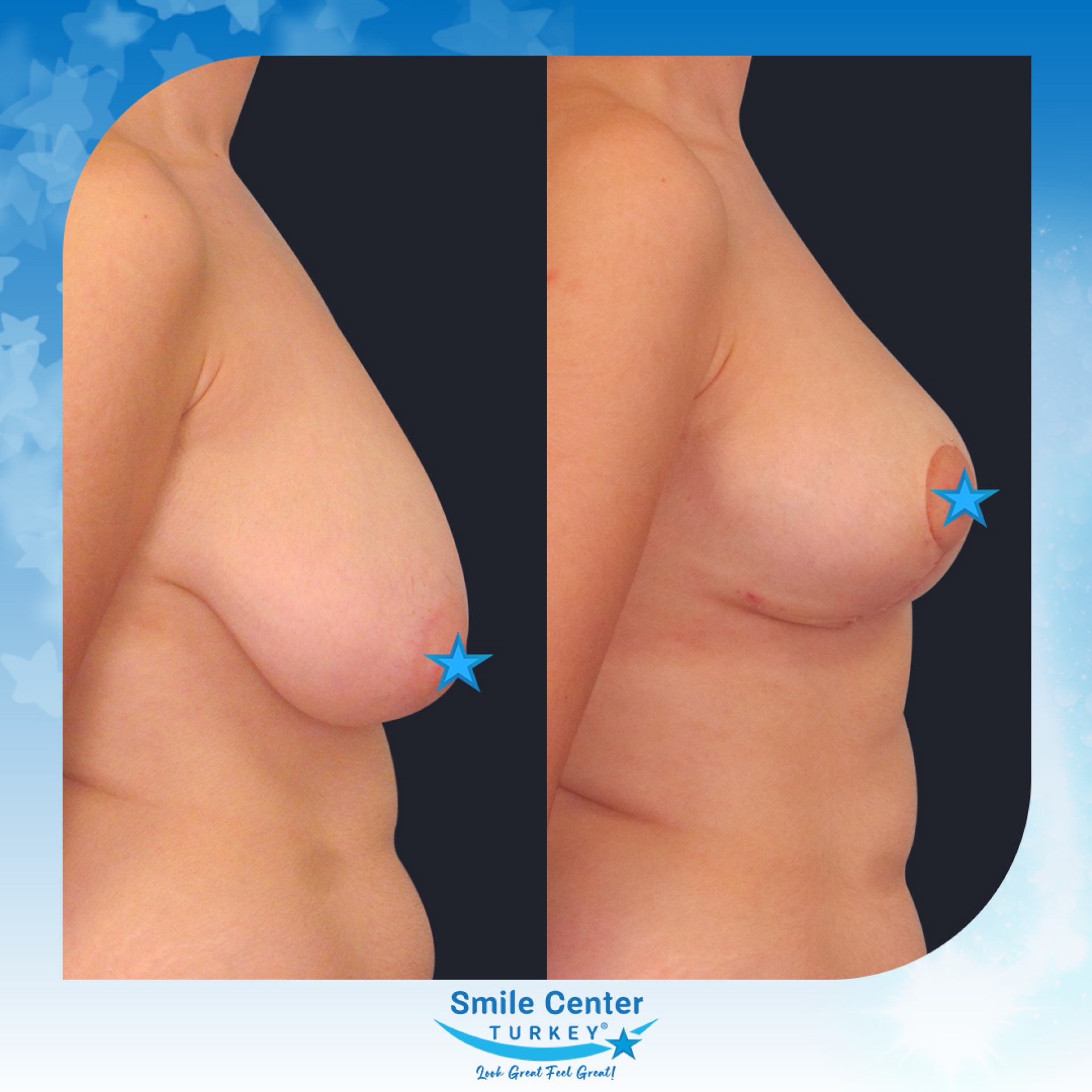 Before and after cosmetic surgery at Smile Center Turkey