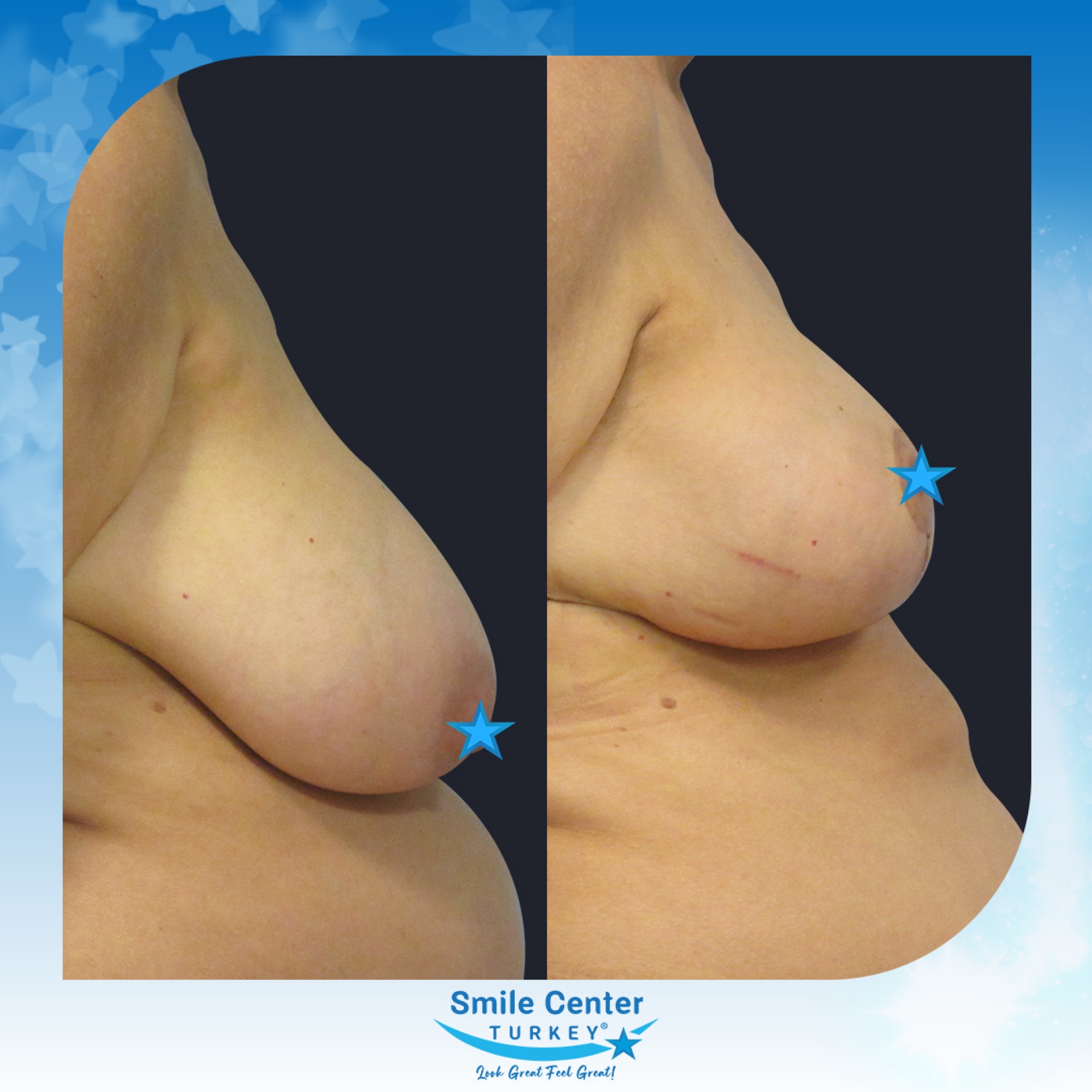 Before and after cosmetic surgery at Smile Center Turkey