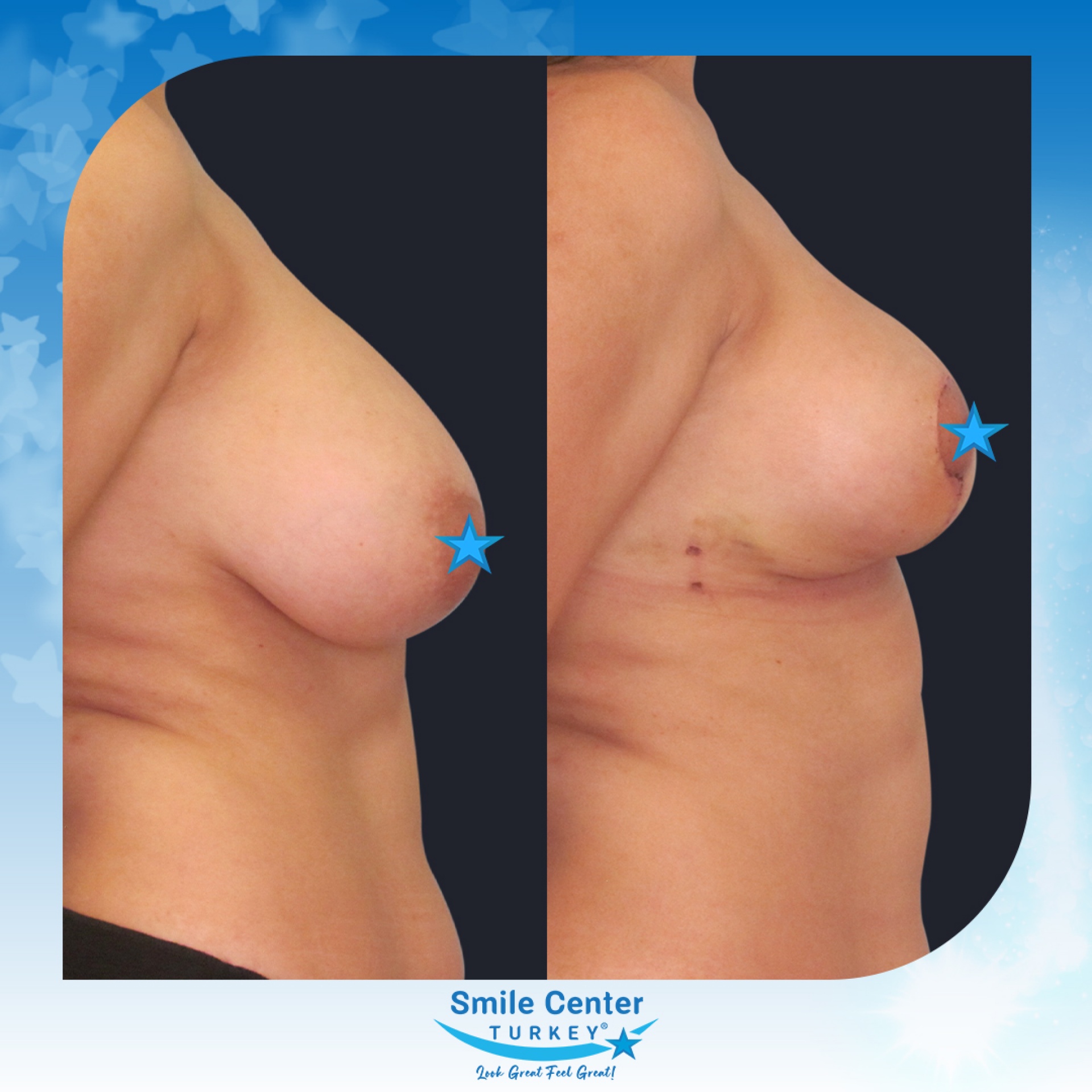 Before and after cosmetic surgery at Smile Center Turkey
