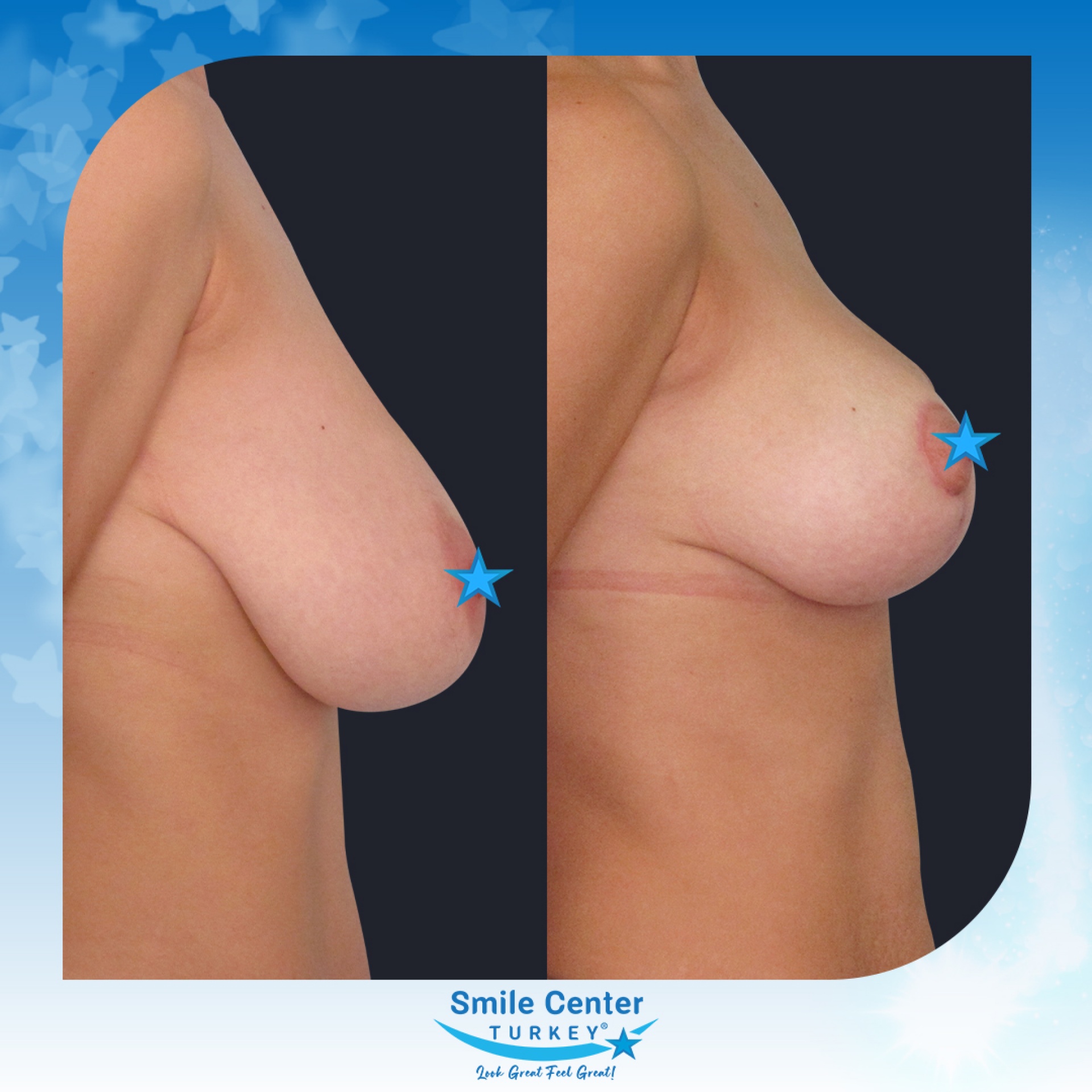 Before and after cosmetic surgery at Smile Center Turkey