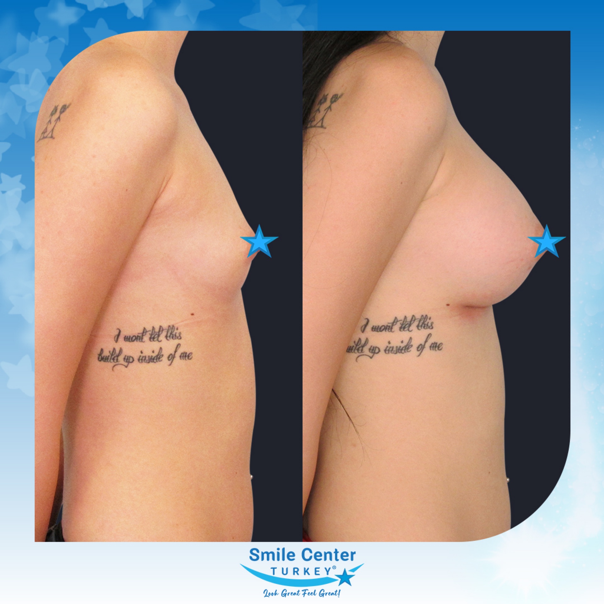Before and after cosmetic surgery at Smile Center Turkey