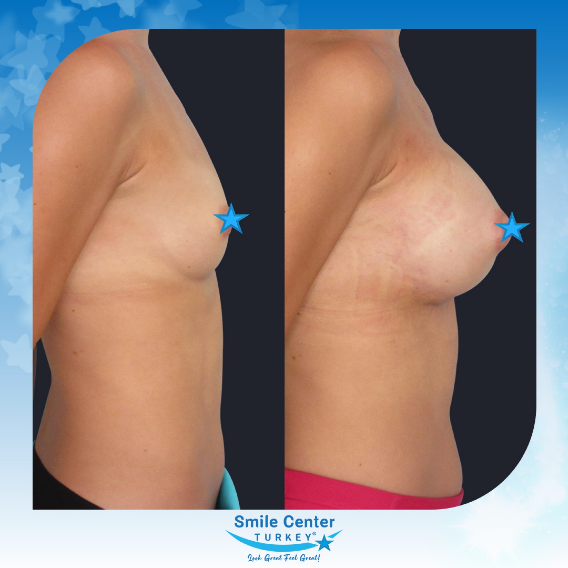 Before and after cosmetic surgery at Smile Center Turkey