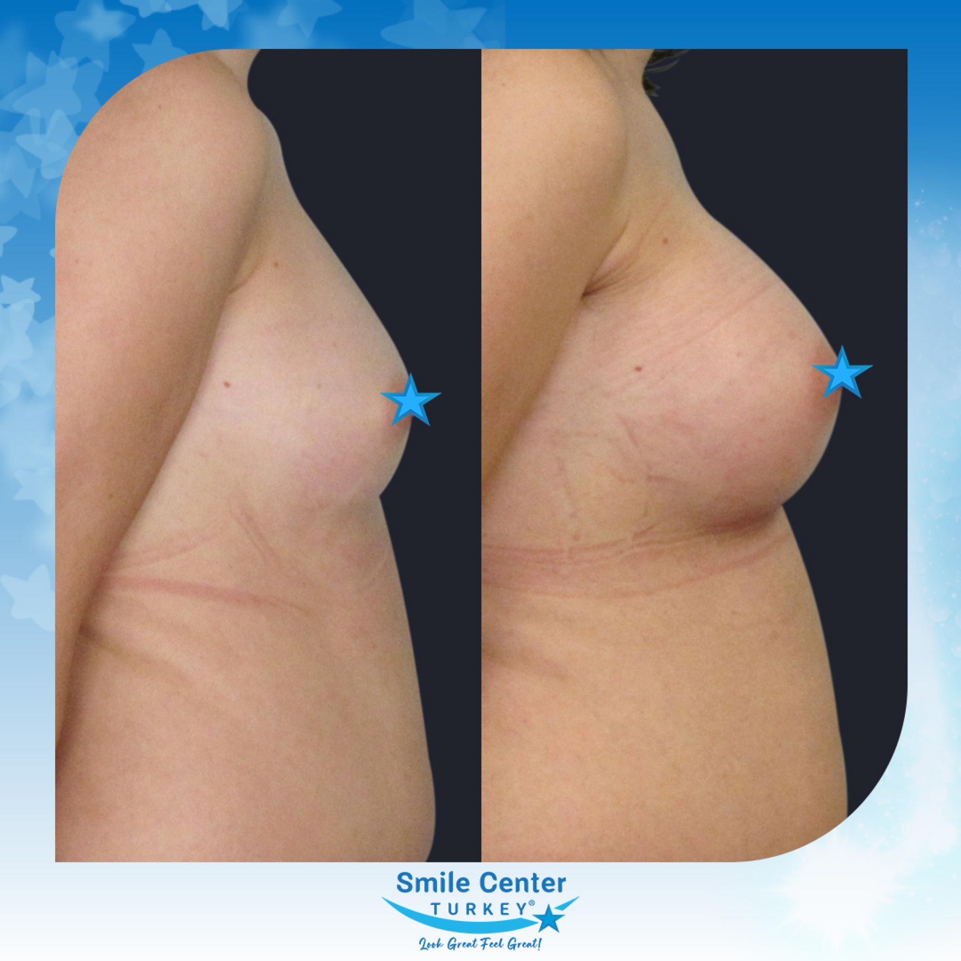 Before and after cosmetic surgery at Smile Center Turkey