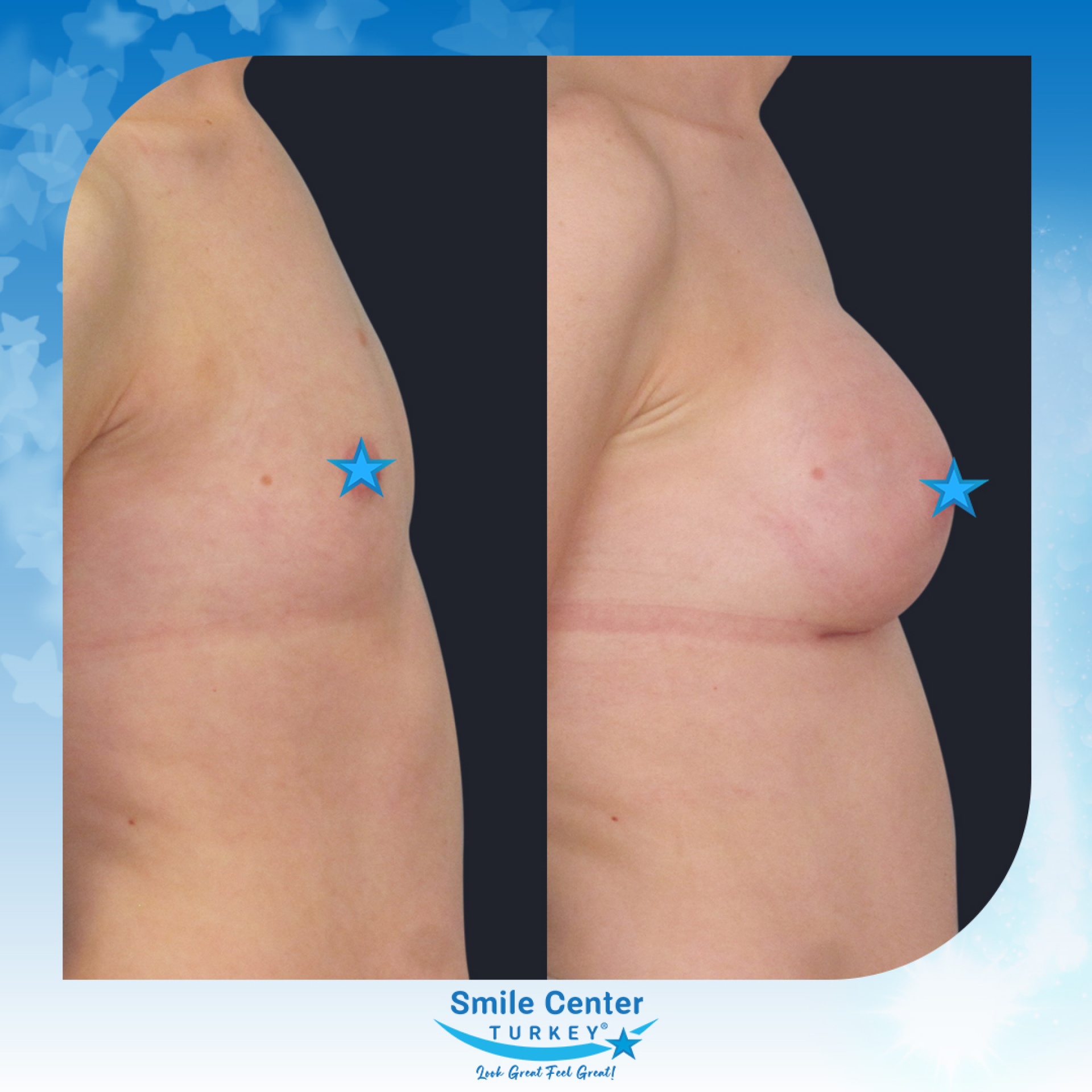Before and after cosmetic surgery at Smile Center Turkey