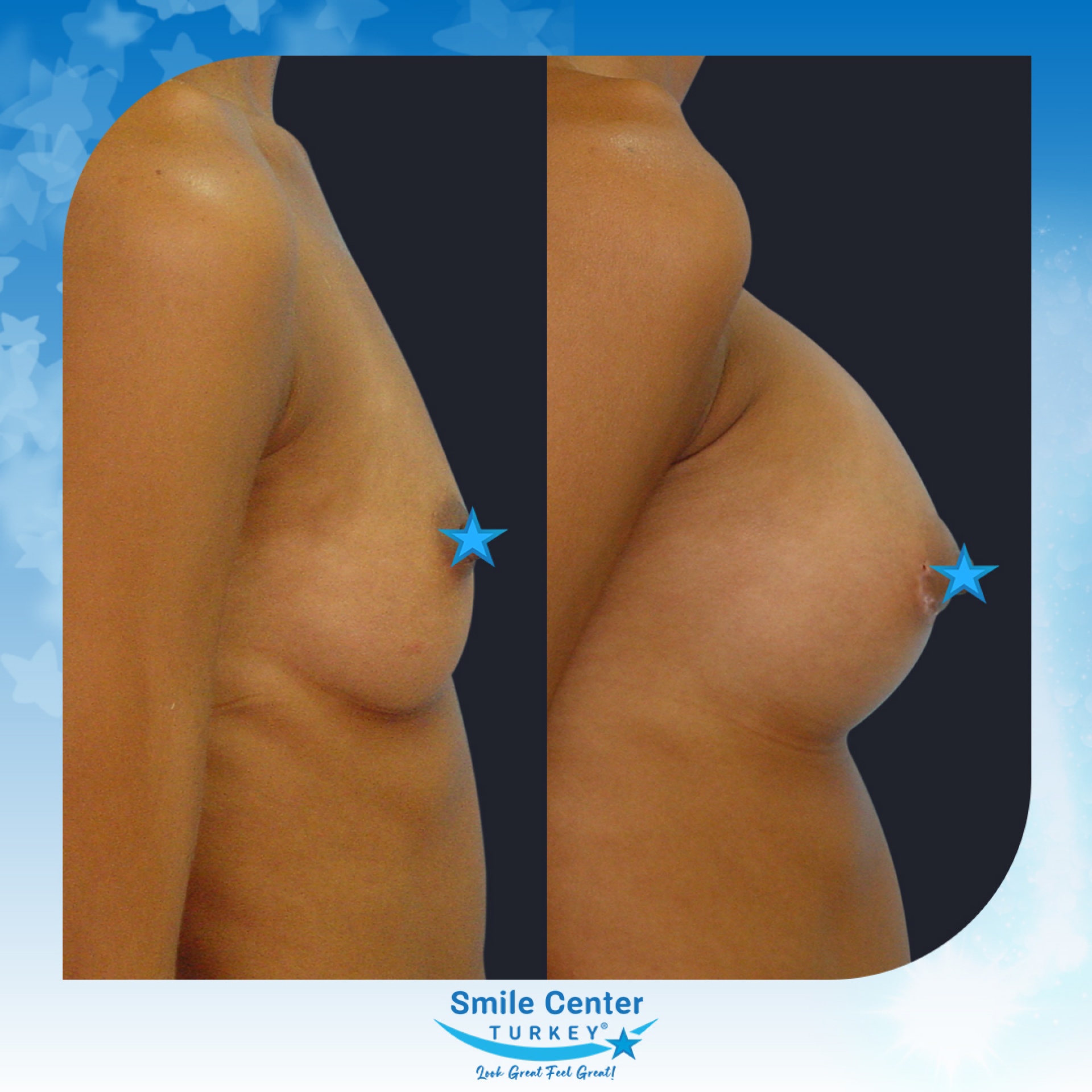 Before and after cosmetic surgery at Smile Center Turkey