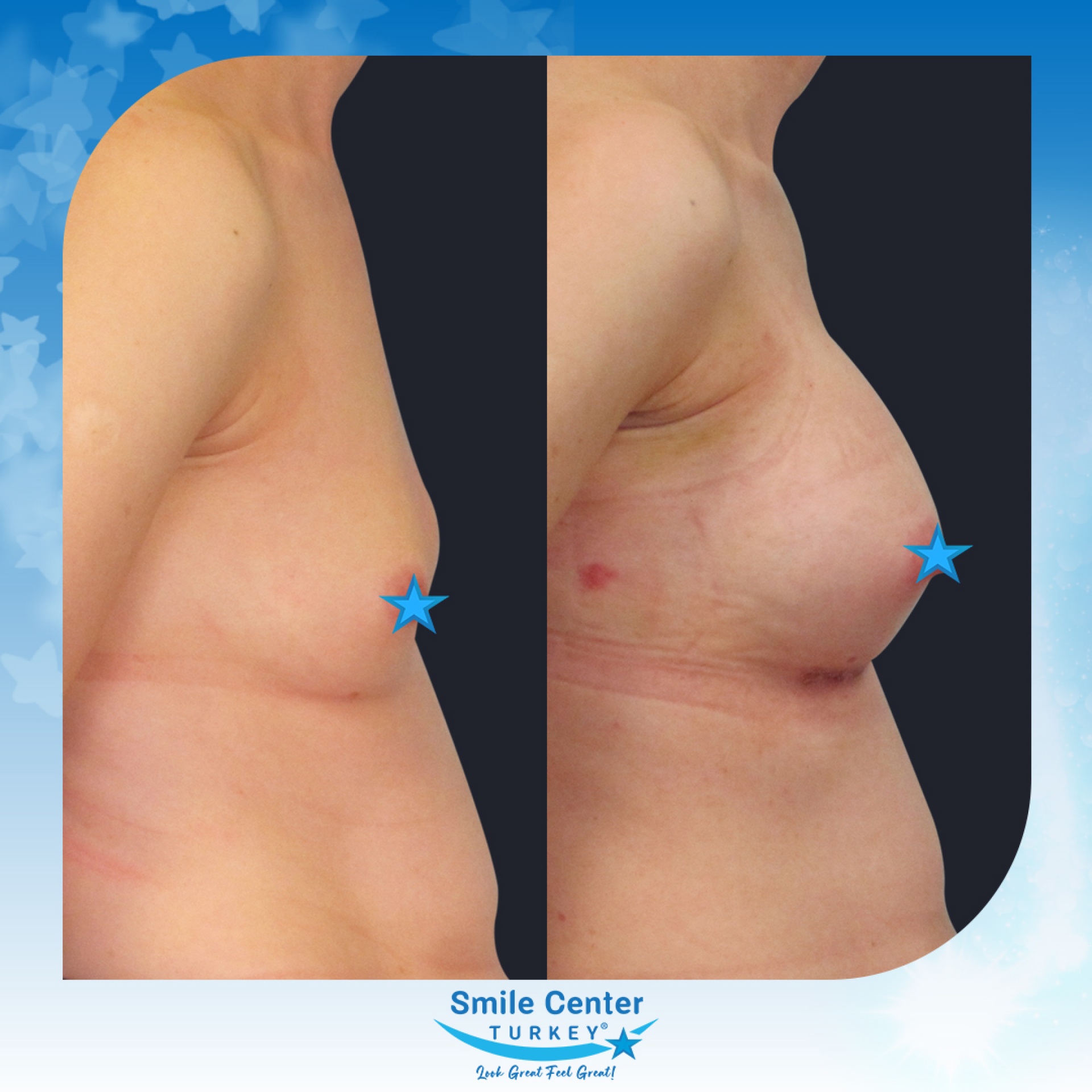 Before and after cosmetic surgery at Smile Center Turkey