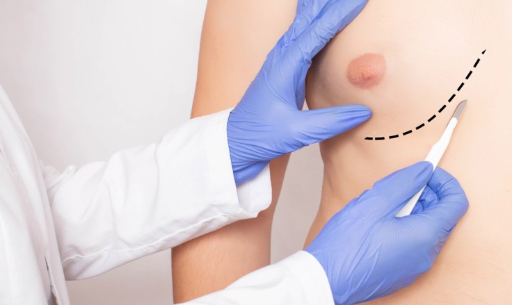 gynecomastia-736x439 (2)