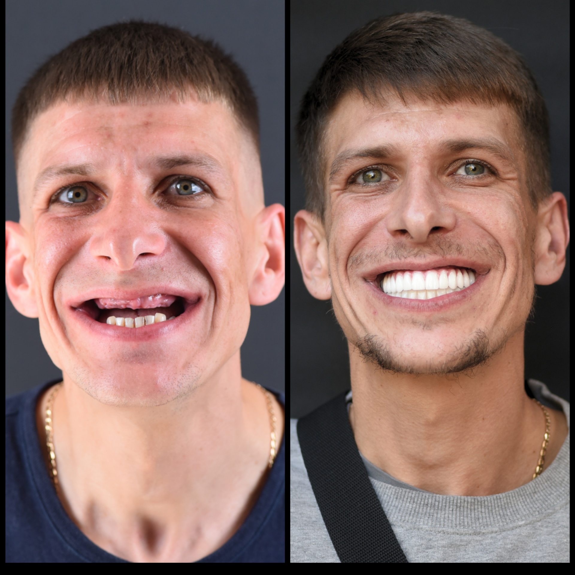 Blog – Smile Center Turkey®