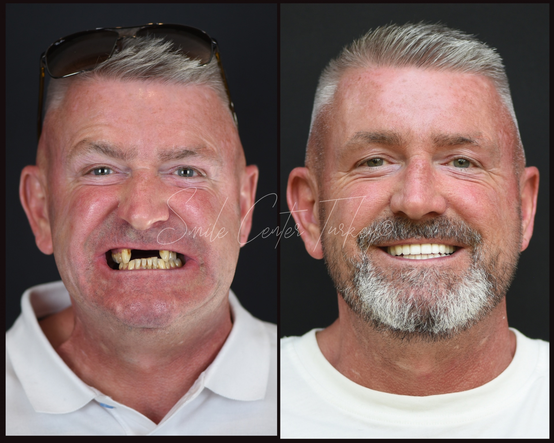 Before and after dental implant treatment in Turkey demonstrating safety, hygiene standards and full smile restoration