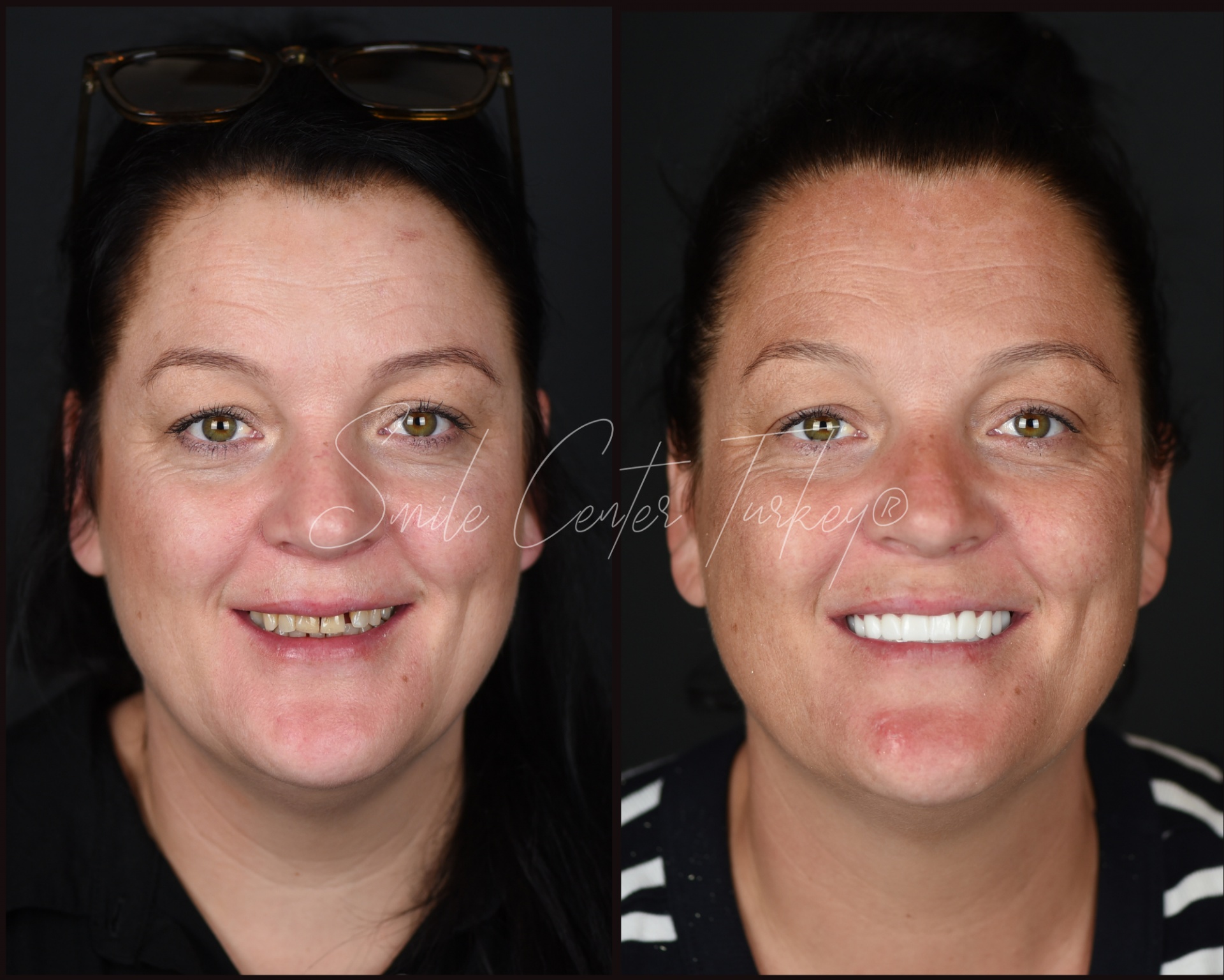 before and after dental treatment in Antalya showing smile transformation for dental tourism patients. Antalya Teeth