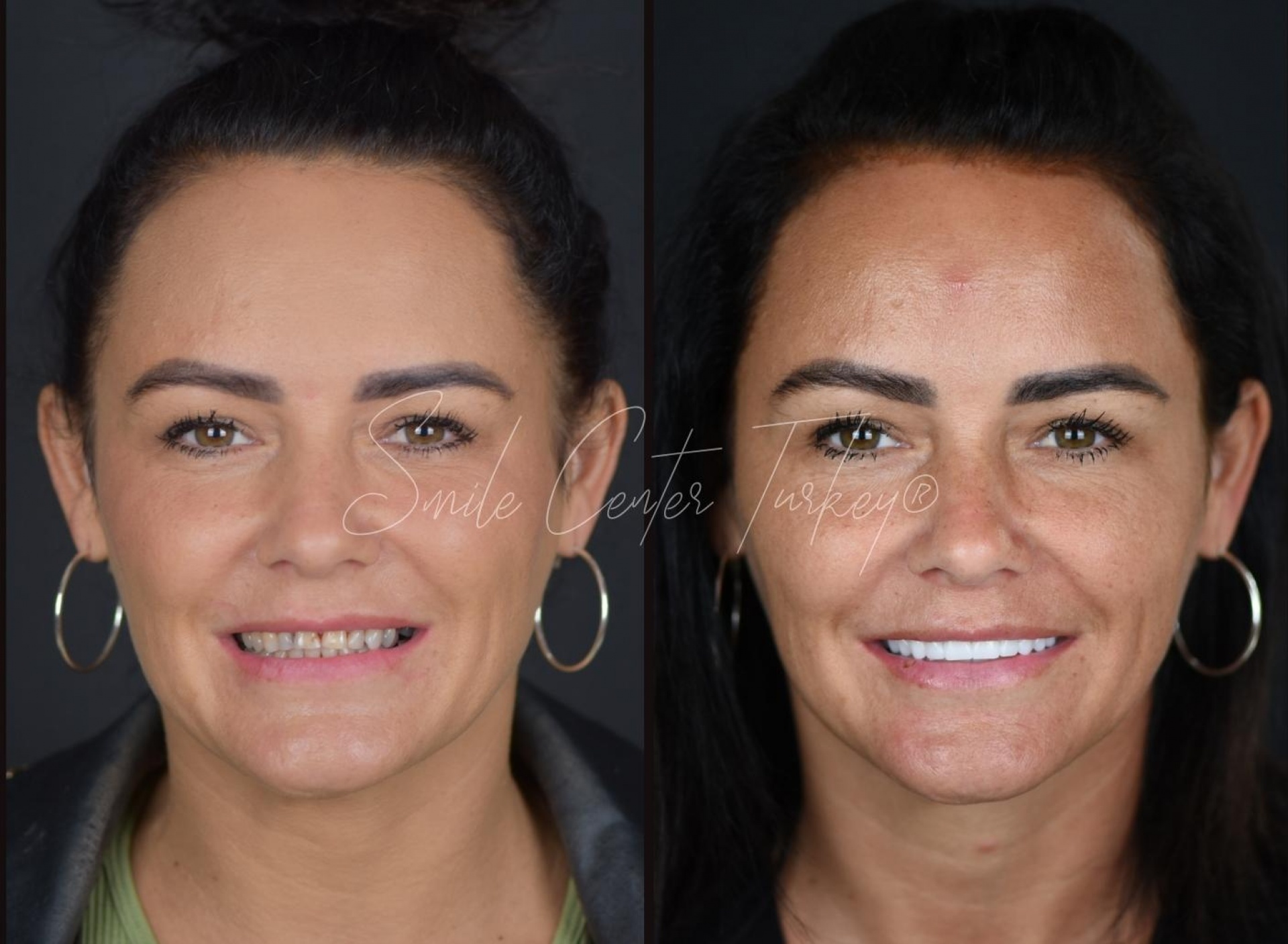 Blog – Smile Center Turkey®