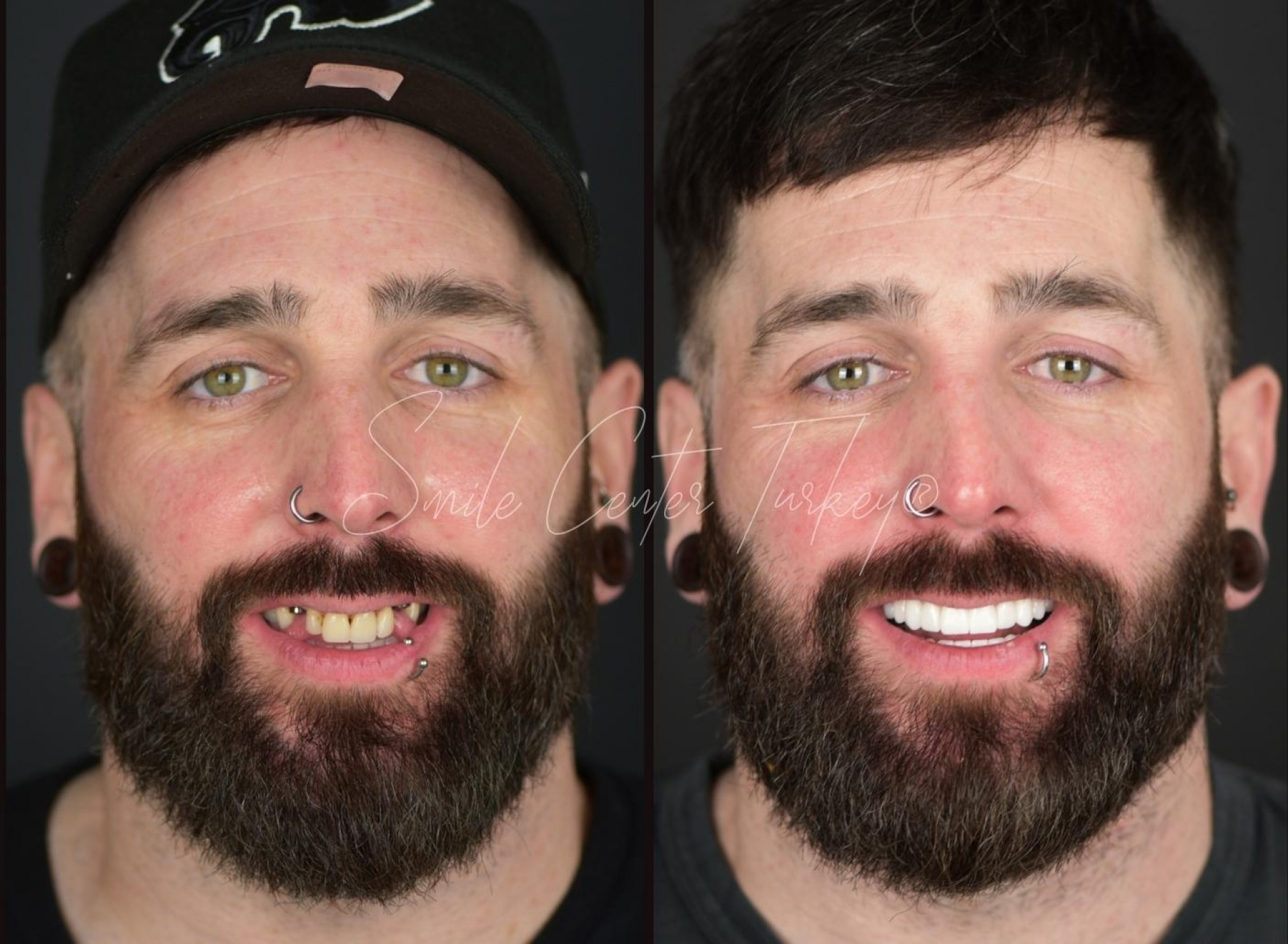 Perfect Teeth in Turkey: How to Achieve a Natural, Beautiful Smile 2026