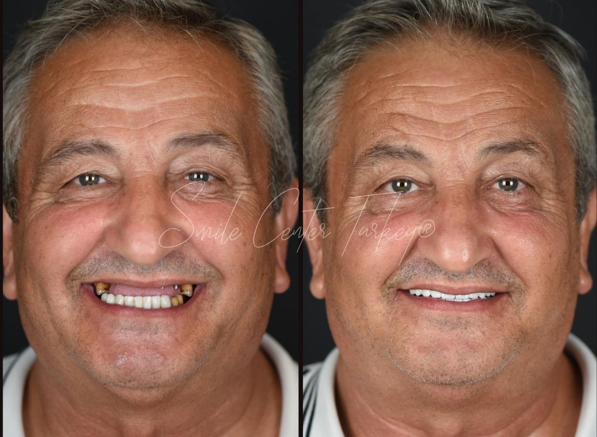 Blog – Smile Center Turkey®