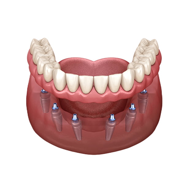 All-on-4 vs All-on-6 Dental Implants in Turkey | Smile Center Turkey 1 Full-arch dental implants concept with digital planning overlays
