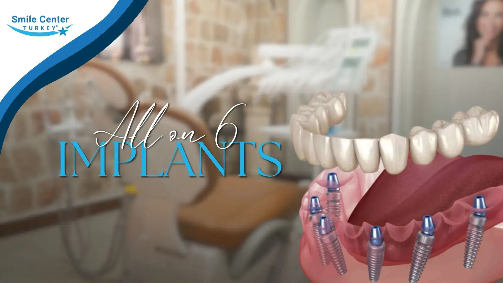 All-on-6 dental implants cover image for full arch replacement in Antalya | Smile Center Turkey