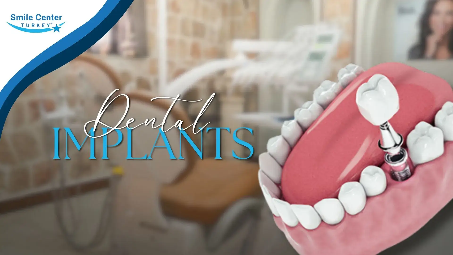 Dental implants cover image for All-on-4 dental implants Antalya Turkey | Smile Center Turkey