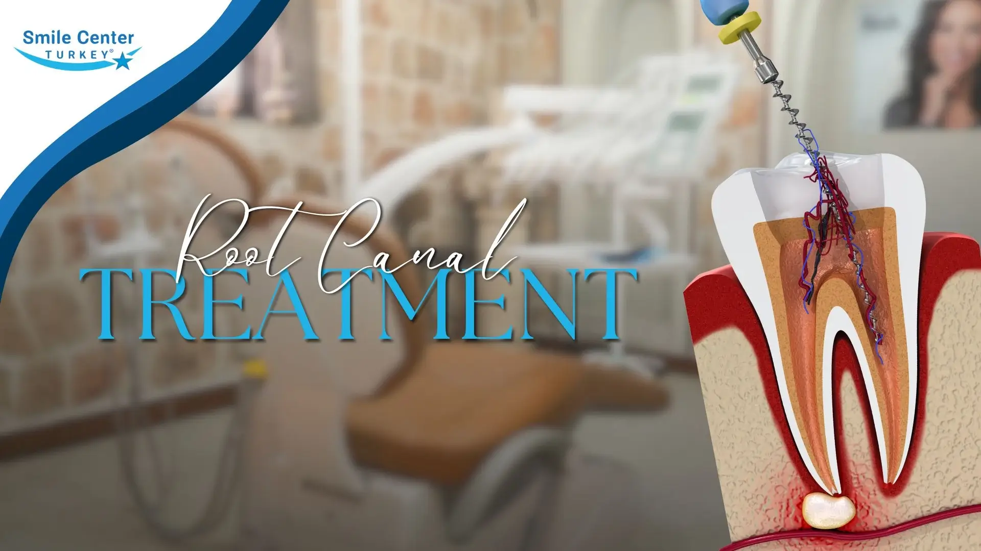 Root canal treatment cover image for endodontic therapy in Antalya | Smile Center Turkey dental clinic
