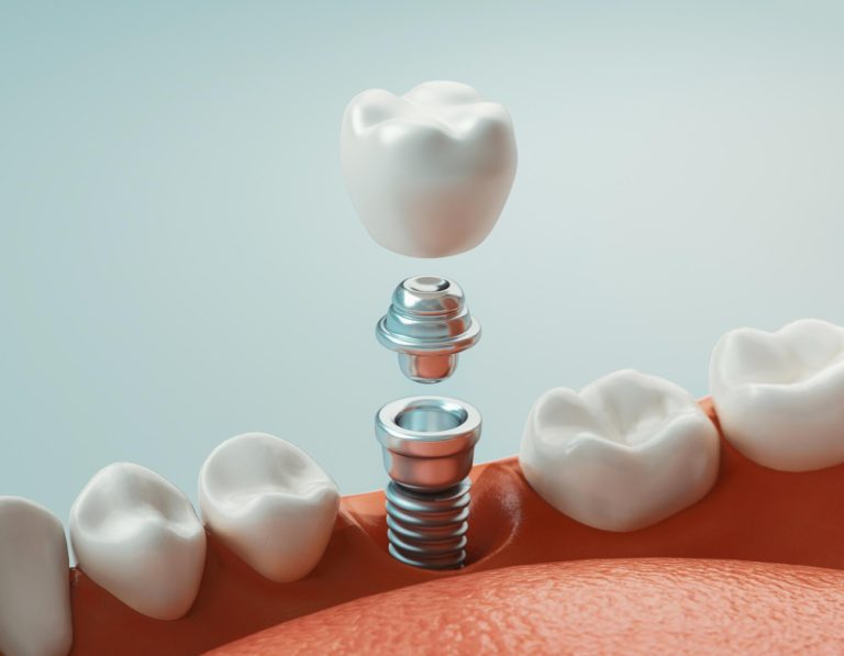 Dental implant components illustration (crown, abutment, screw) — dental implants in Antalya, Turkey for UK patients | Smile Center Turkey