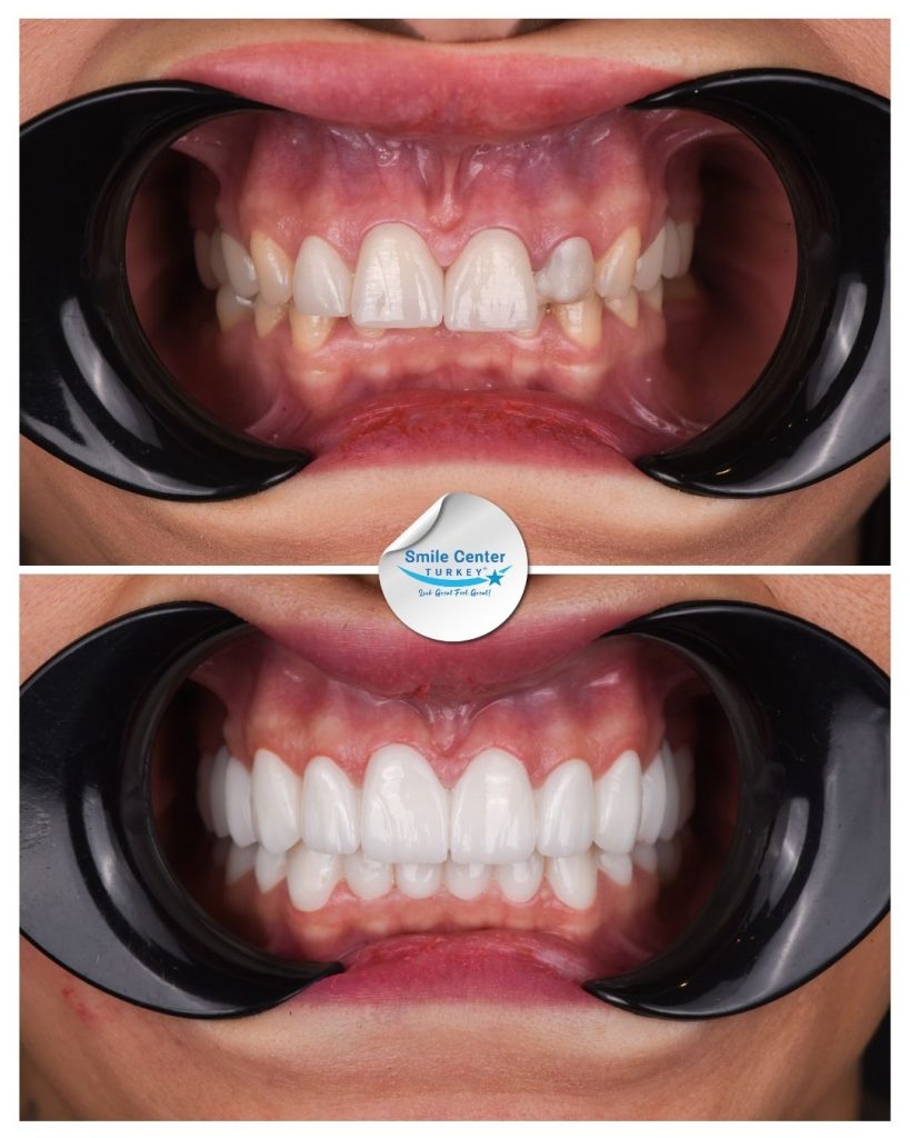 Duygu K. – Smile Center Turkey®