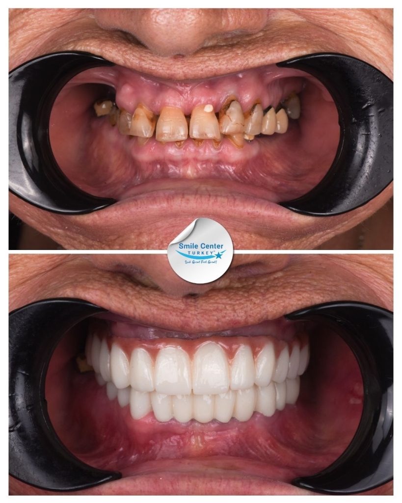 June H. – Smile Center Turkey®