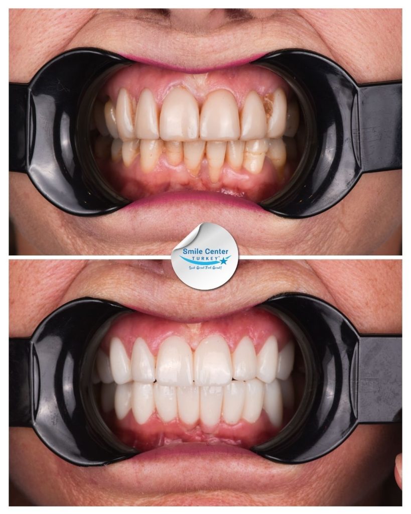 Veronica D. – Smile Center Turkey®