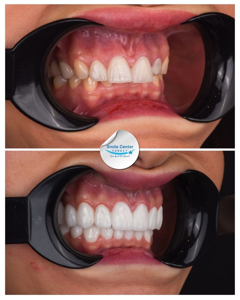 Duygu K. – Smile Center Turkey®
