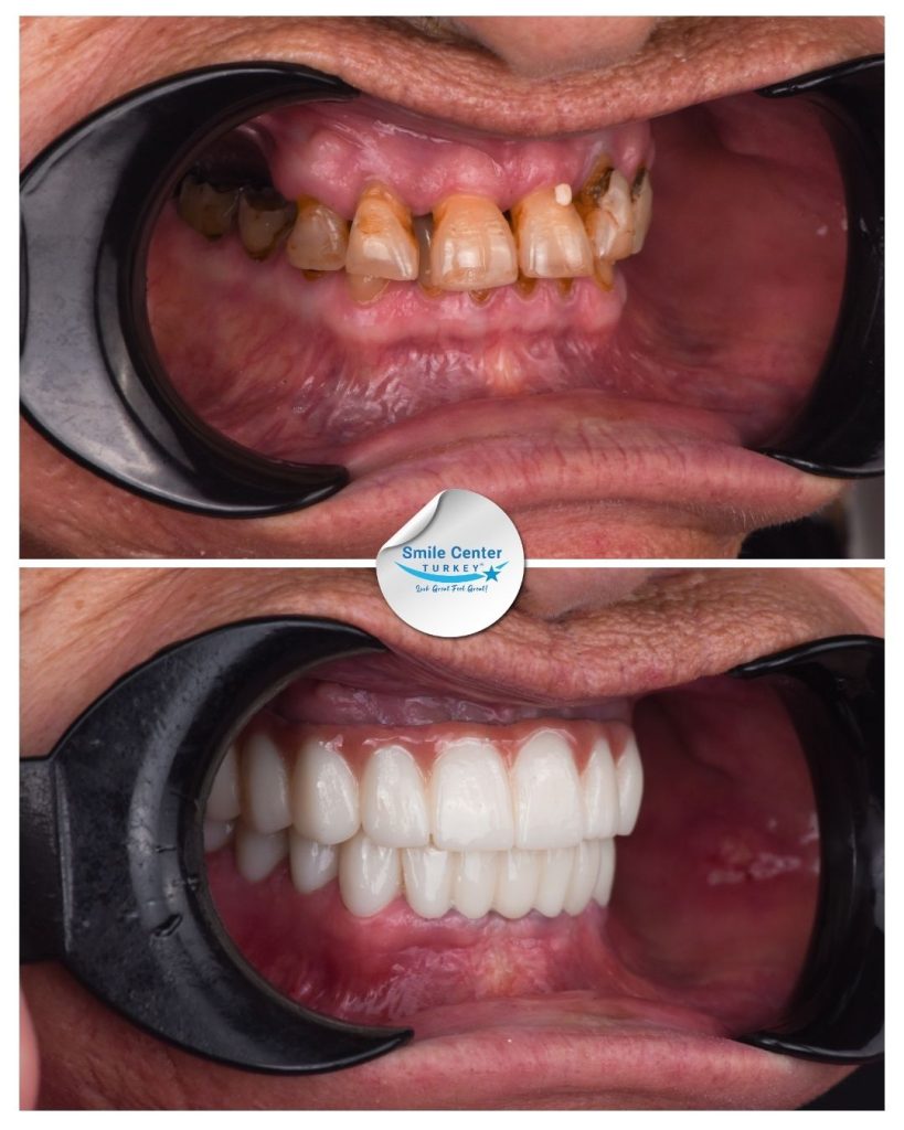 June H. – Smile Center Turkey®