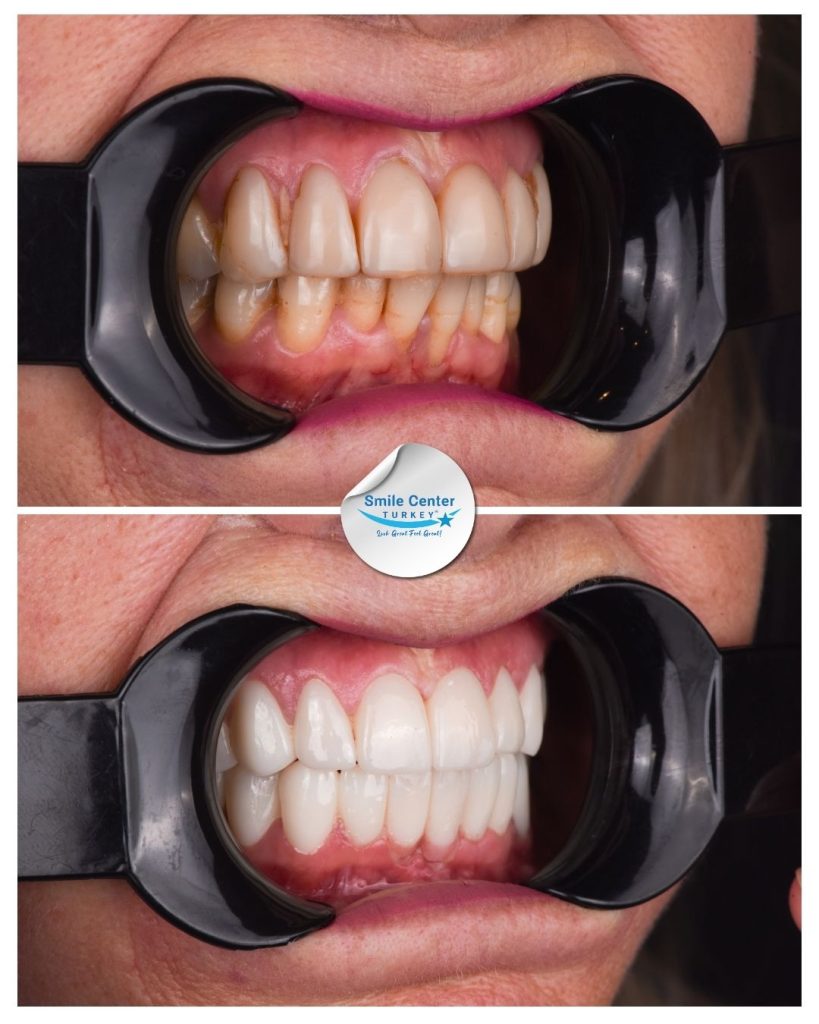Veronica D. – Smile Center Turkey®