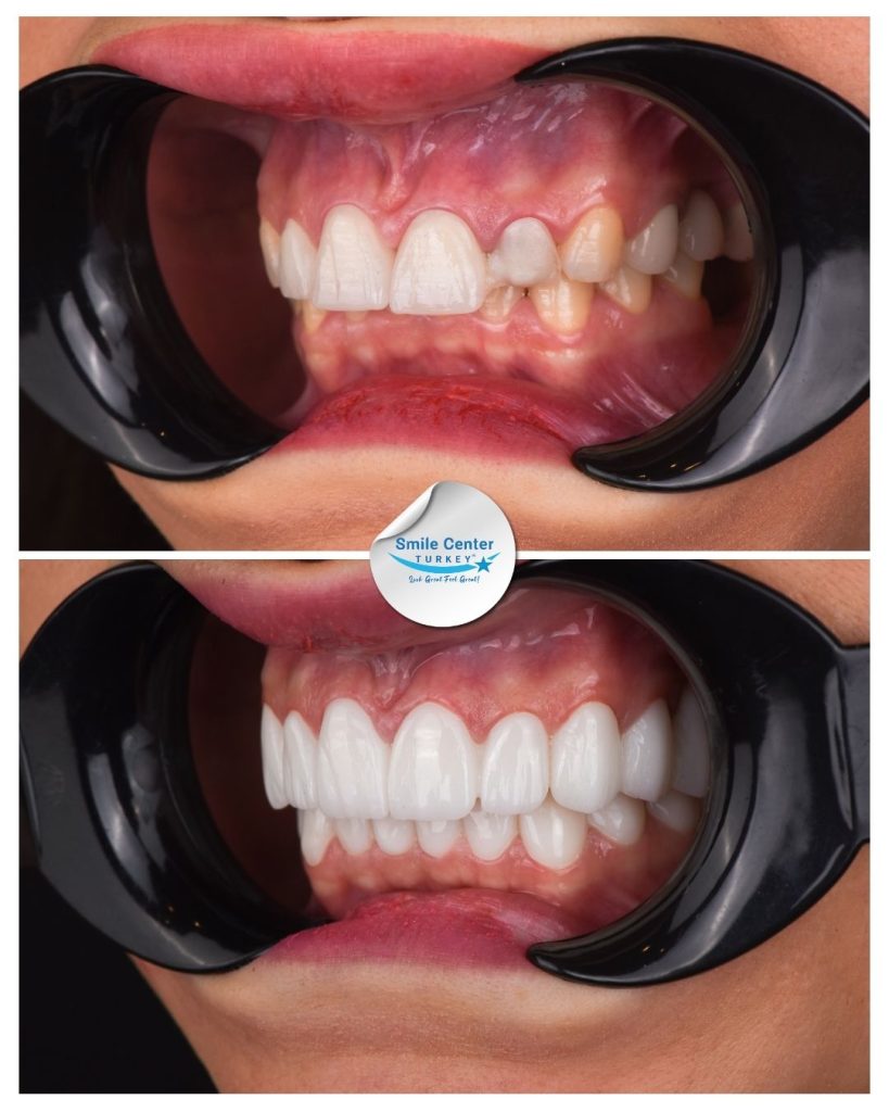 Duygu K. – Smile Center Turkey®