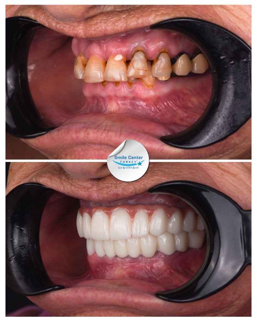 June H. – Smile Center Turkey®