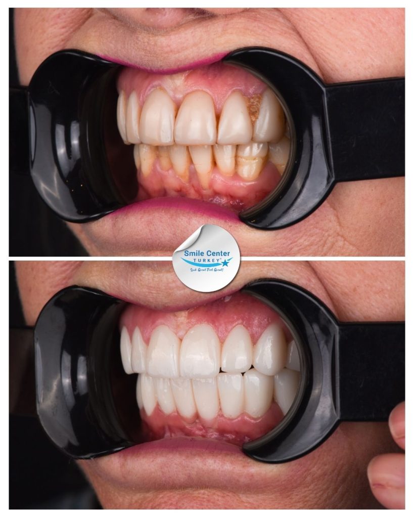 Veronica D. – Smile Center Turkey®