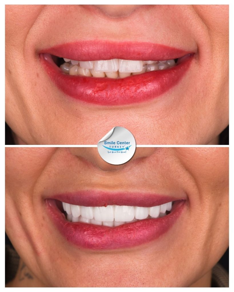 Duygu K. – Smile Center Turkey®